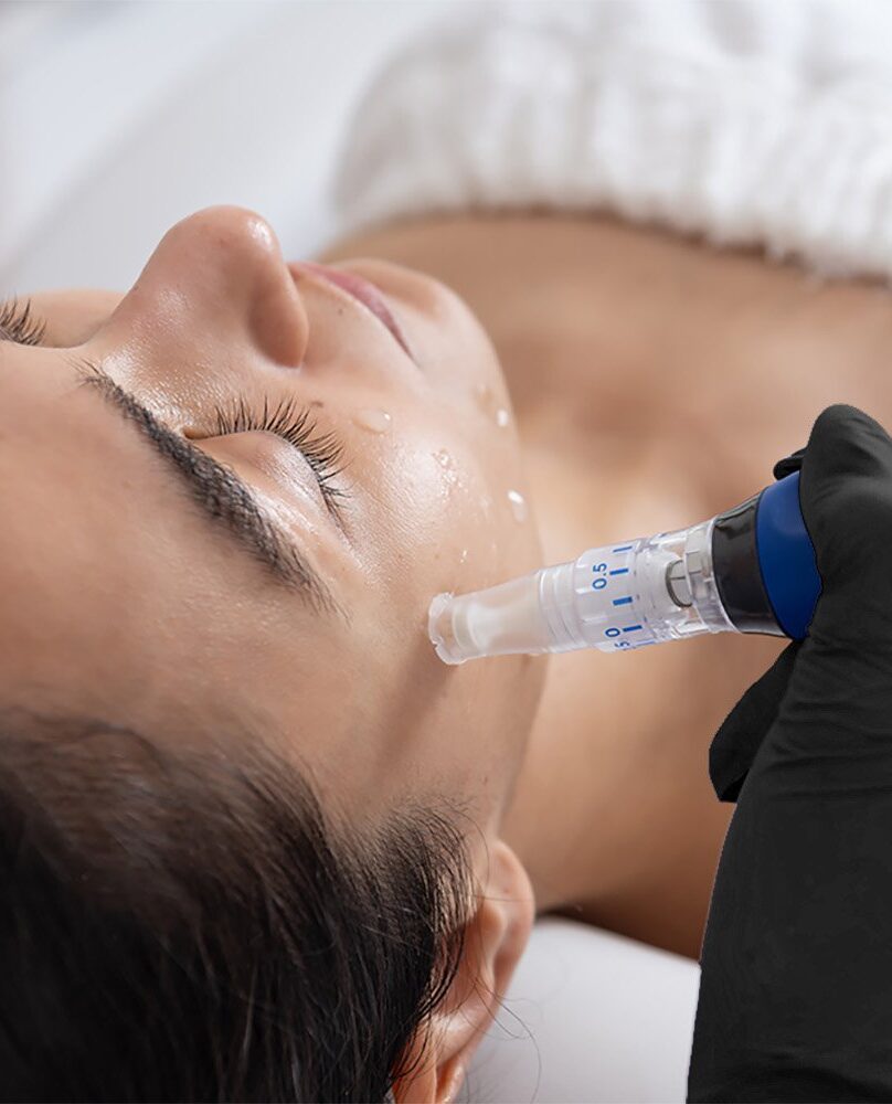 Skinpen microneedling Oak Brook