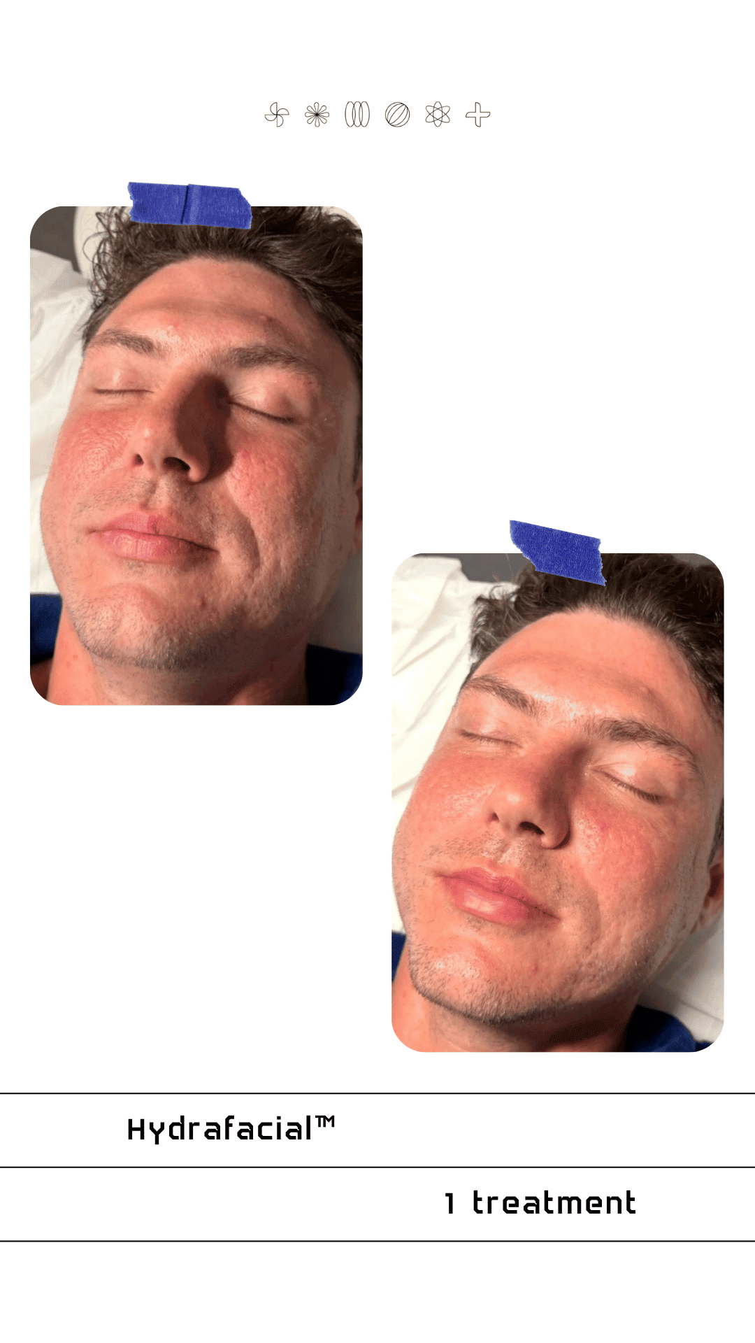 Men hydrafacial at ethr lab oak brook